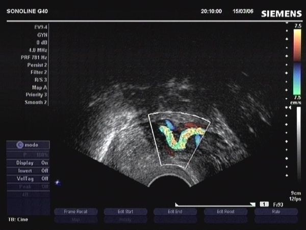 Obr. 2.4. Zobrazení „kolénka“ děložní tepny (arteria uterina) pomocí barevné dopplerovské ultrasonografie 