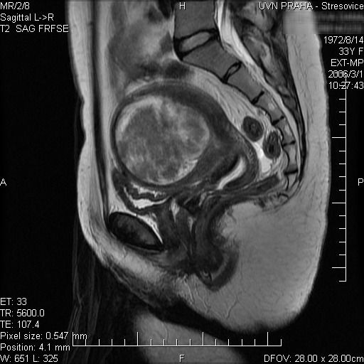 Obr. 2.6. Objemný, solitární myom přední stěny děložní při zobrazení magnetickou rezonancí 